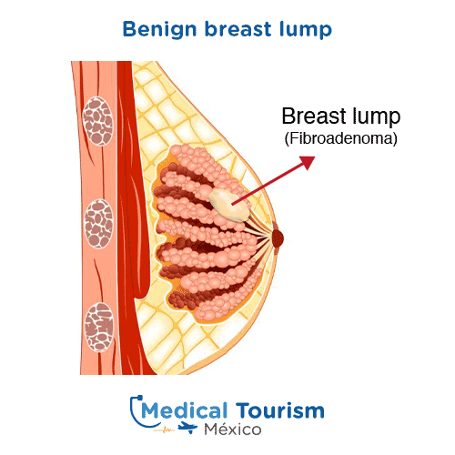 Illustrative image of Benign breast conditions