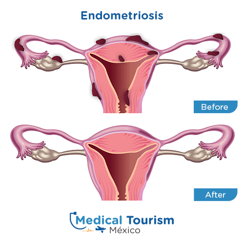Illustrative image of Endometriosis