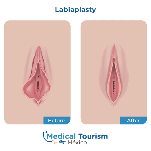 Illustrative image of Labiaplasty