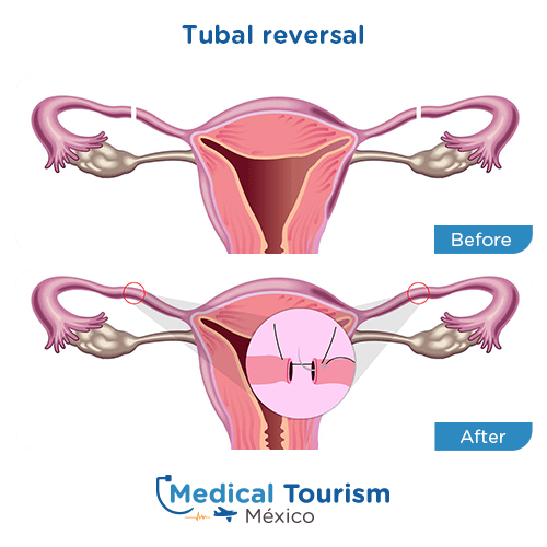 Illustrative image of Tubal ligation reversal