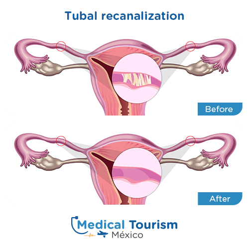 Illustrative image of Tubal recanalization