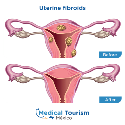 Illustrative image of Uterine fibroids