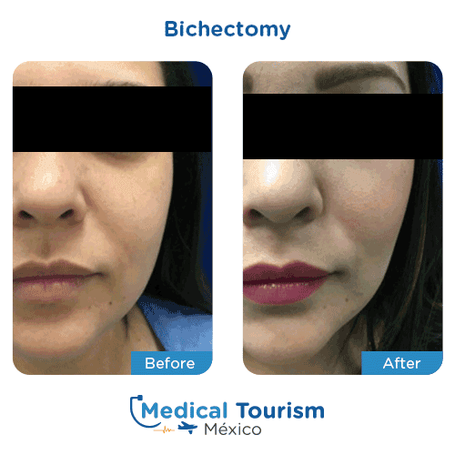 Patient before and after Bichectomy