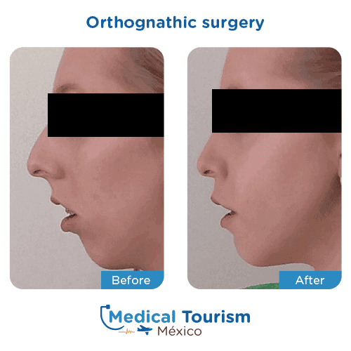 Patient before and after jaw surgery