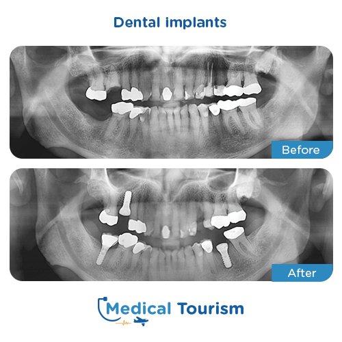 Dental implant before and after medical tourism 