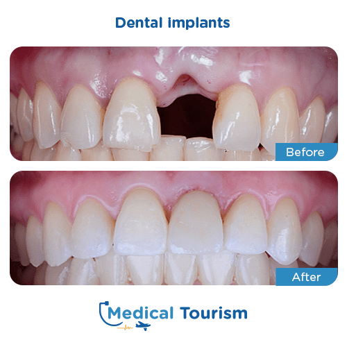 Dental implant before and after medical tourism 