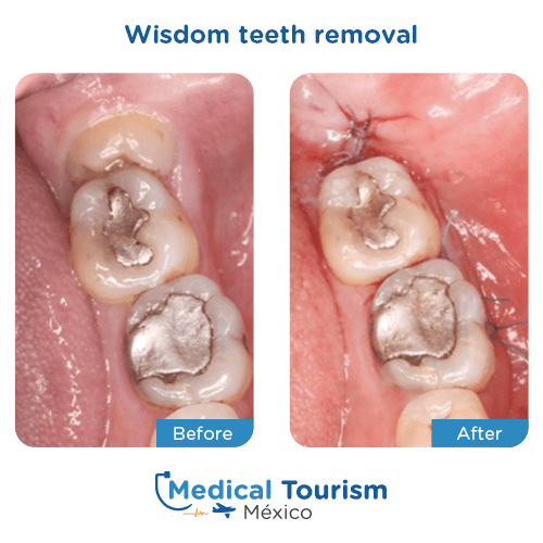 Wisdom teeth imapct illustrative image