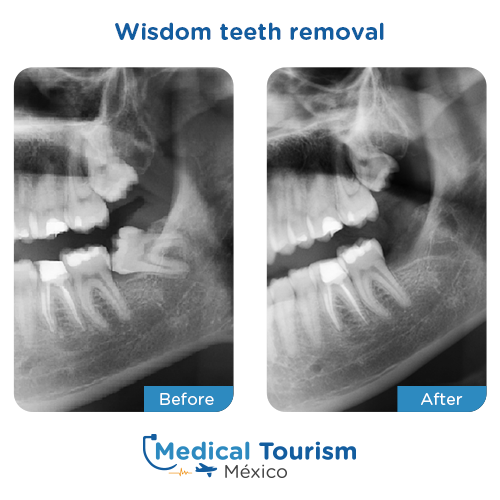 Wisdom teeth imapct illustrative image