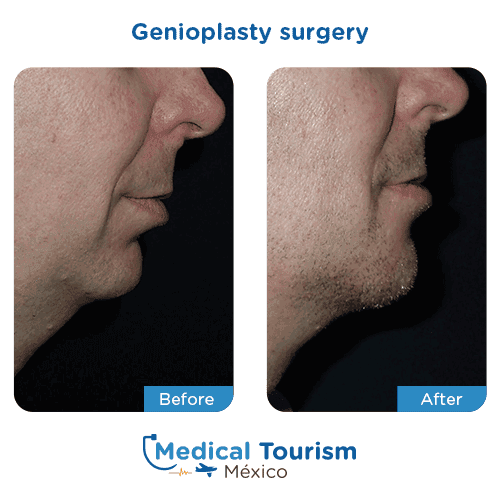 Patient before and after chin surgery