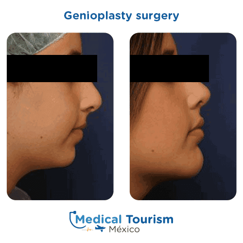 Patient before and after chin surgery