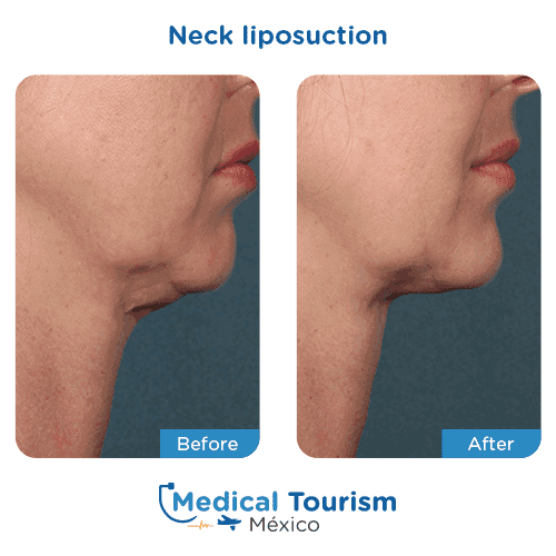 Patient before and after neck liposuction