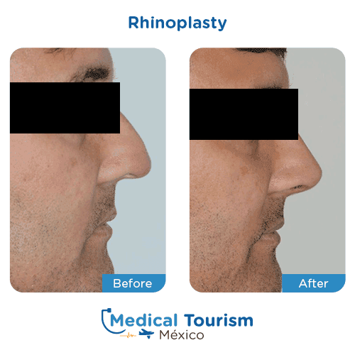 Patient before and after nose surgery