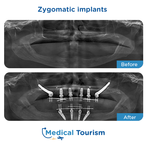 Zygomatic implant before and after medical tourism