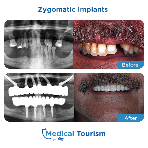 Zygomatic implant before and after medical tourism 