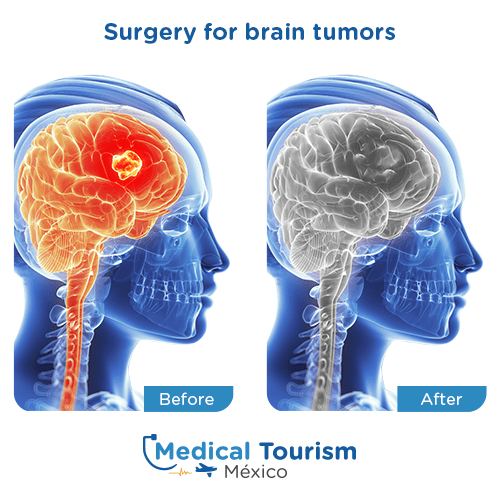 Illustrative image of Brain tumors