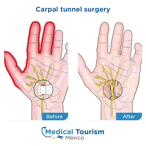 Illustrative image of carpal tunnel surgery