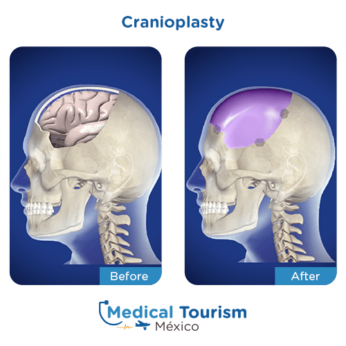Illustrative image of cranioplasty