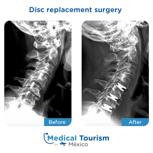 Illustrative image of Disc replacement surgery