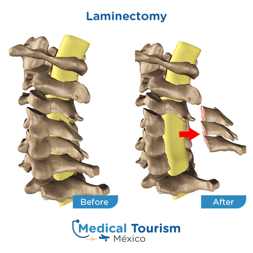 Illustrative image of Laminectomy