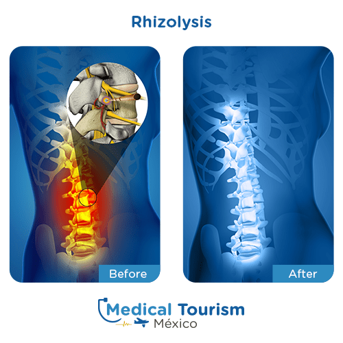 Illustrative image of Rhizolysis