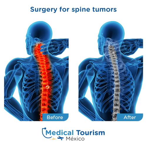 Illustrative image of Spine tumors