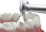 Endodontics procedure
