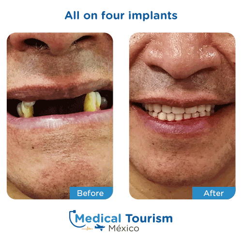 Patient before and after all on four implants