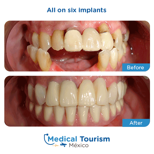 Patient before and after all on six implants