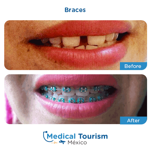 Patient before and after braces