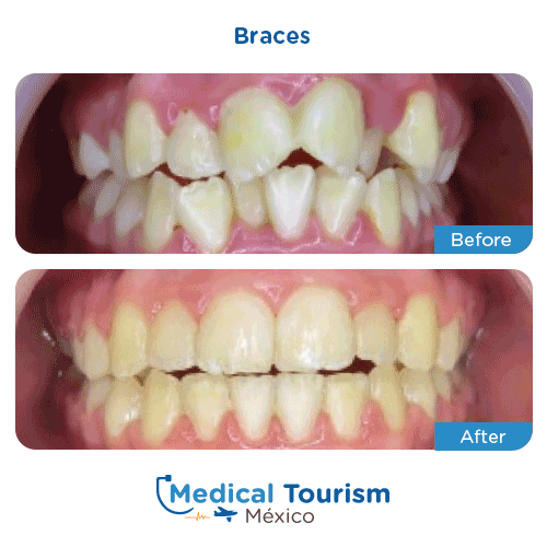 Patient before and after braces