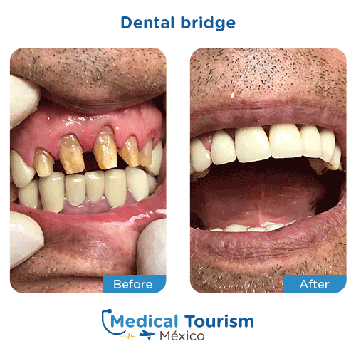 Patient before and after dental bridge