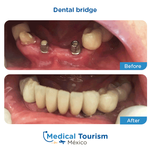 Patient before and after dental bridge