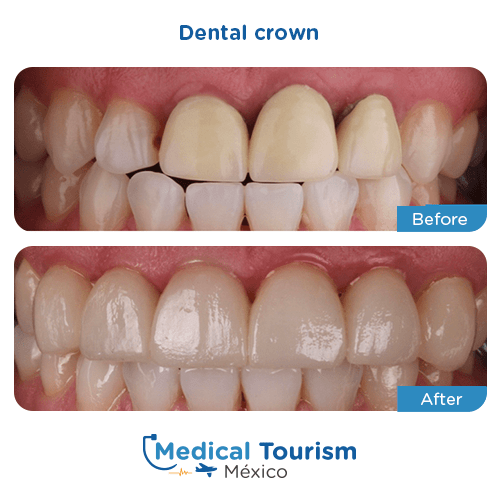 Patient before and after dental crown