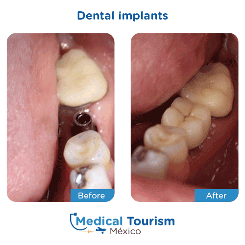 Patient before and after dental implant