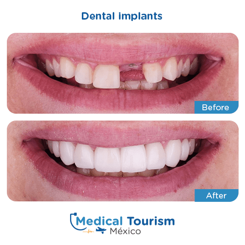 Patient before and after dental implant