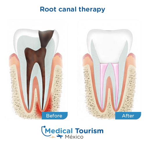 Illustrative image of a root canal