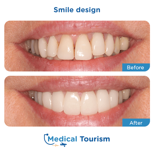 Patient before and after smile design