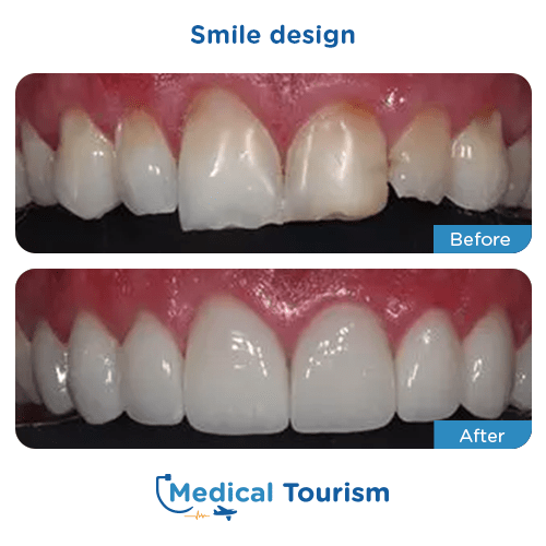 Patient before and after smile design