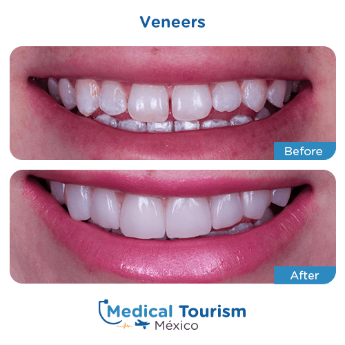 Patient before and after dental veneers
