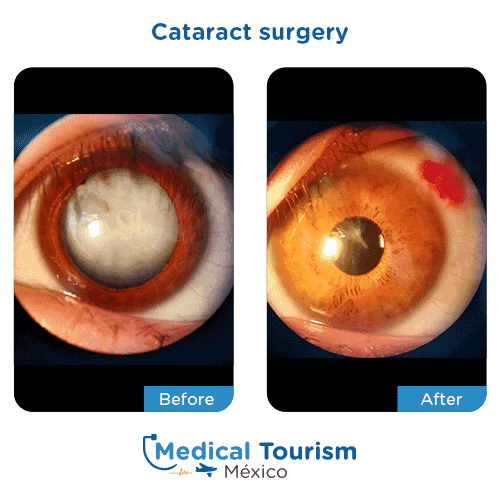 Patient before and after cataract surgery