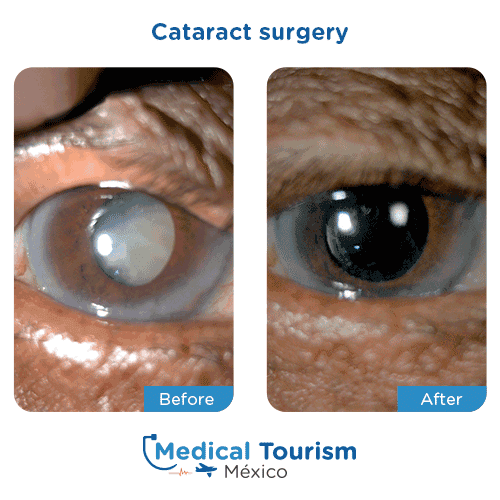 Patient before and after cataract surgery