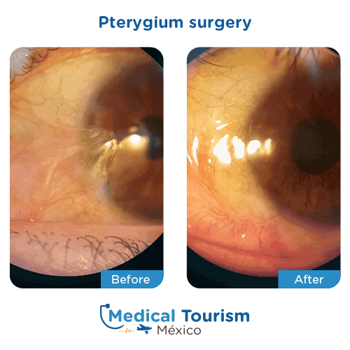 Patient before and after pterygium surgery