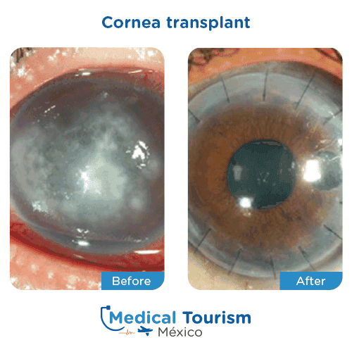 Patient before and after glaucoma surgery