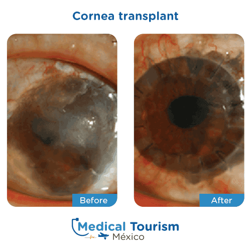 Patient before and after glaucoma surgery