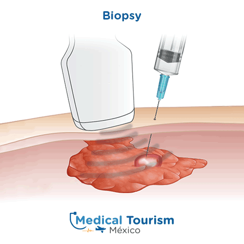 Illustrative image of Biopsy