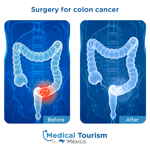 Illustrative image of Colon cancer