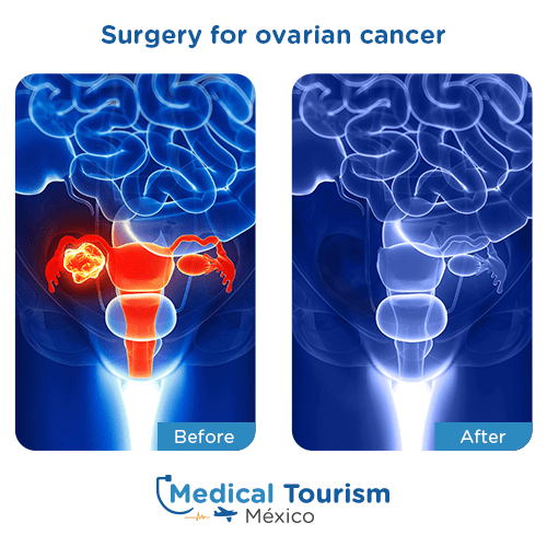 Illustrative image of Ovarian cancer