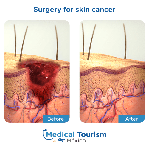 Illustrative image of Skin cancer