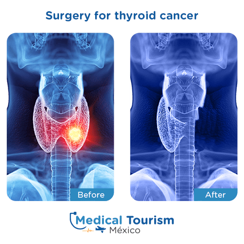 Illustrative image of Thyroid cancer