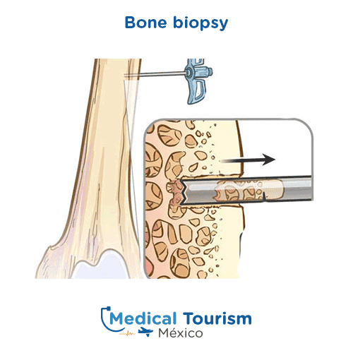 Illustrative image of a bone biopsy